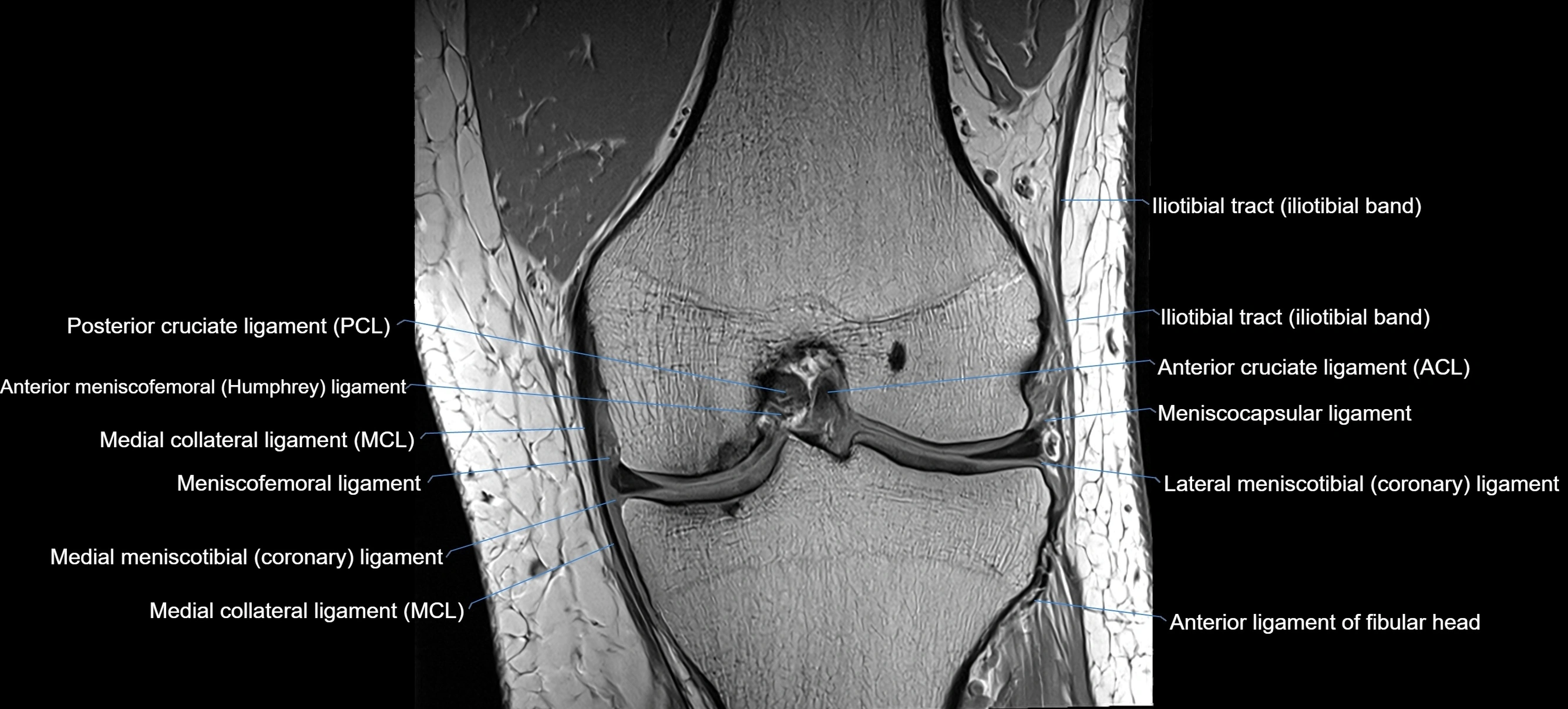 MRI coronal  ligaments cross sectional anatomy 3T  radiology  image-img-04001-00021.webp